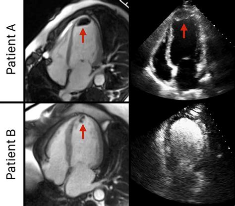 left ventricular thrombus heart attack